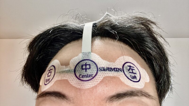 株式会社S’UIMINの睡眠検査の電極を貼り付けた様子